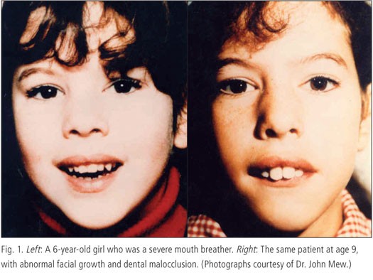Signs of mouth breathing in children